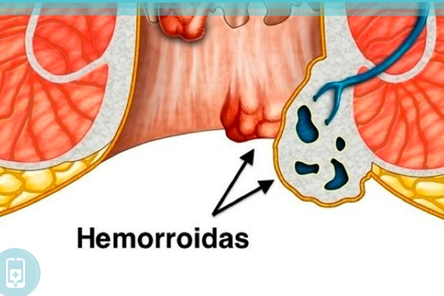 Hemorroidas inflamadas - O que é?