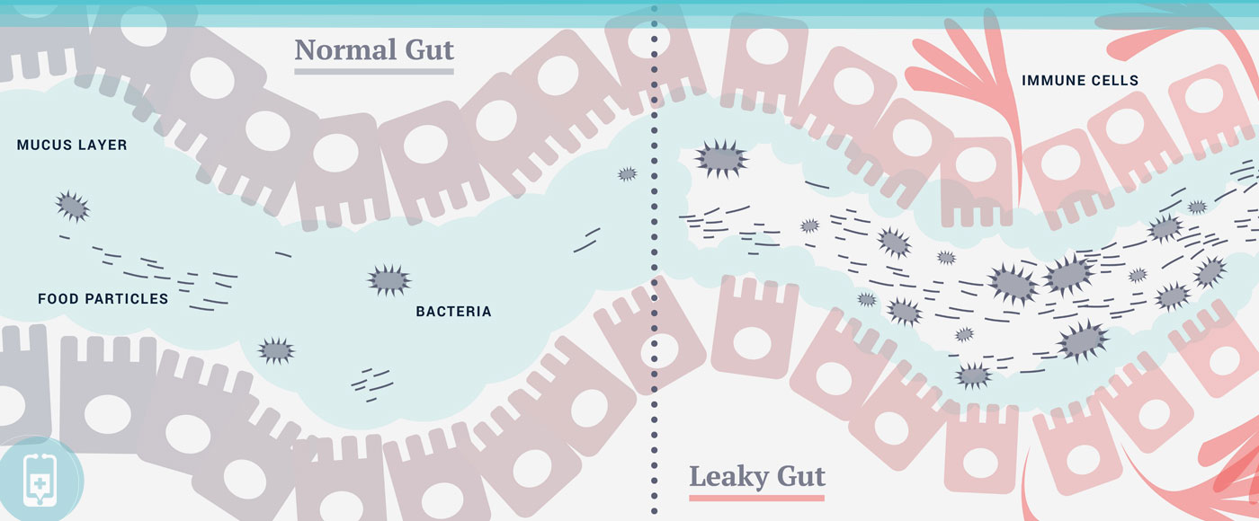 Leaky Gut - Permeabilidade intestinal