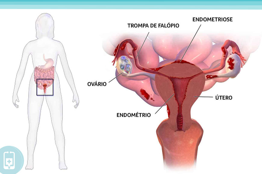 Rapidamente: O que é Endometriose?